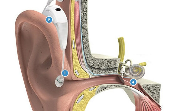 1- Implante Coclear